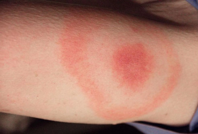 Example of Lyme disease